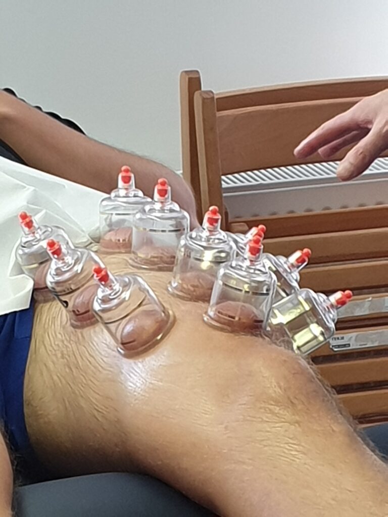 Dry Cupping